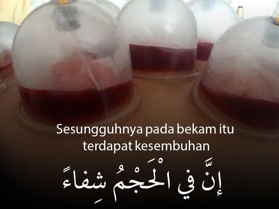 hukum berbekam